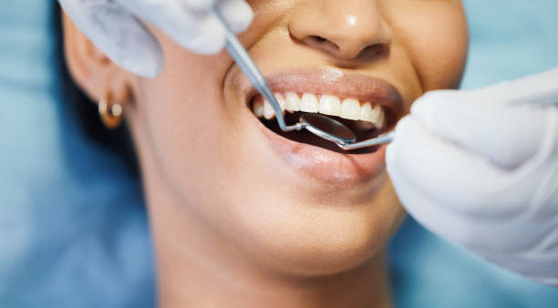 Best Emergency Wisdom Tooth Extraction in Watsonville, CA